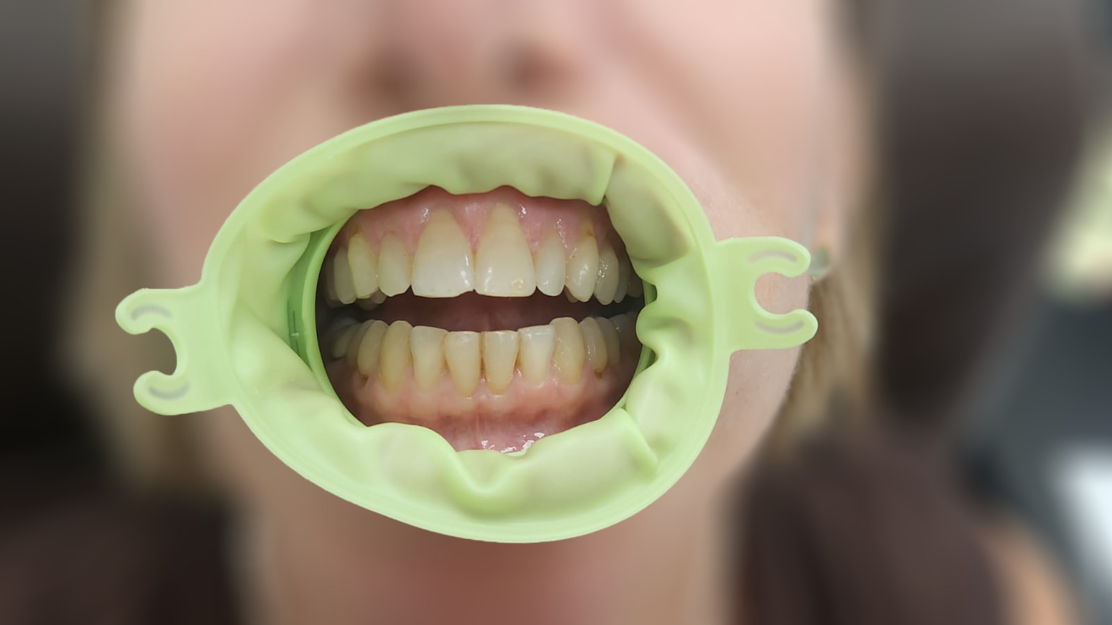פותח פה שפתיים חד פעמי קטן COTISEN