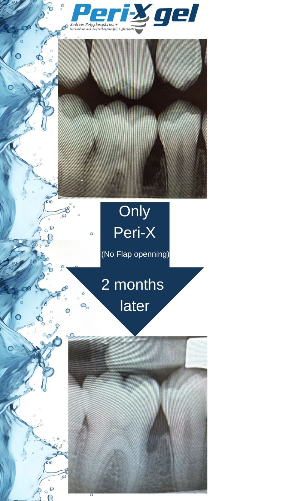 PERI-X GEL לטיפול בפריאימפלנטיטיס